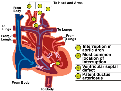 Congenital Heart Defects